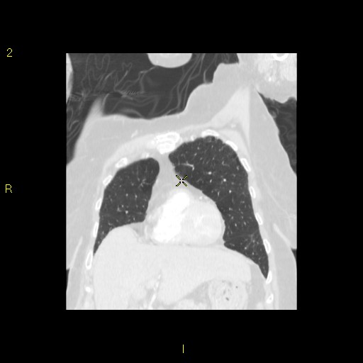 File:Bronchogenic carcinoma as an incidental finding (Radiopaedia 16453-16130 Coronal lung window 17).jpg