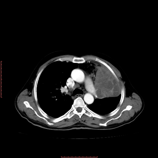 File:Bronchogenic carcinoma with left atrial large deposit - T4N3M1a (Radiopaedia 42316-45428 A 12).jpg