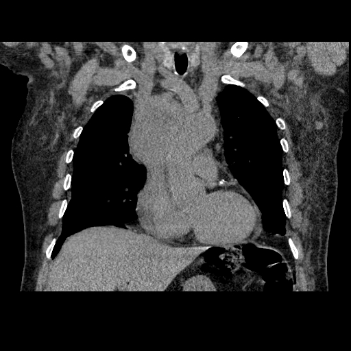 File:Bronchogenic carcinoma with metastatic lymphadenopathy (Radiopaedia 37671-39569 Coronal non-contrast 18).jpg