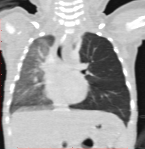 Bronchogenic cyst (Radiopaedia 78599-91409 Coronal lung window 119).jpg