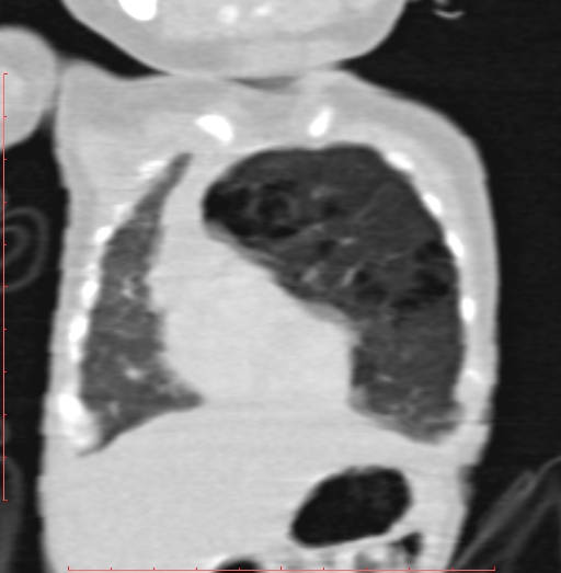 Bronchogenic cyst (Radiopaedia 78599-91409 Coronal lung window 58).jpg