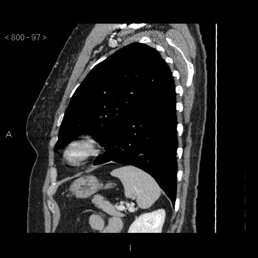 Bronchogenic cyst - posterior mediastinal (Radiopaedia 43885-47364 B 64).jpg