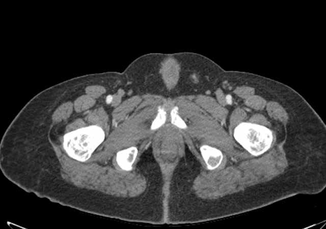 Brown tumors compressing the spinal cord (Radiopaedia 68442-77988 E 133).jpg