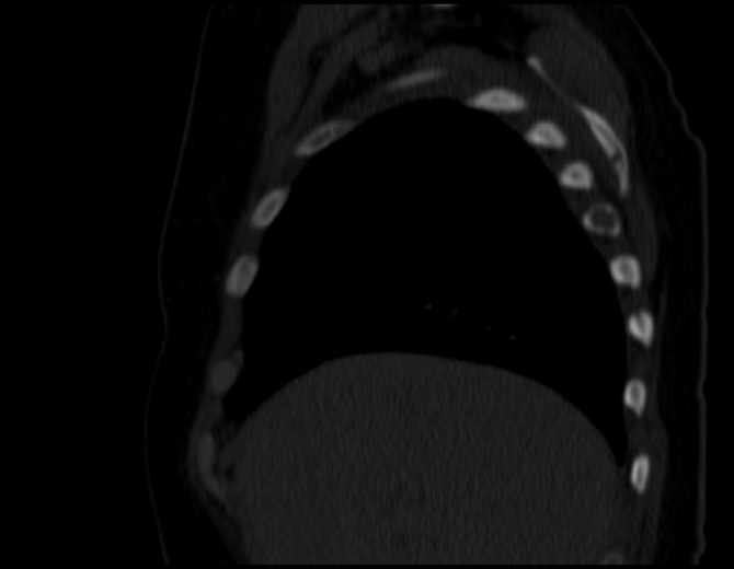 Brown tumors compressing the spinal cord (Radiopaedia 68442-77988 Sagittal bone window 14).jpg