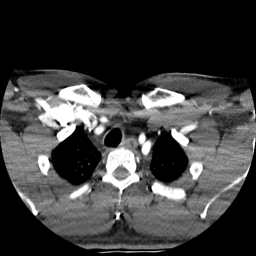Buccal fat pad arteriovenous malformation (Radiopaedia 70936-81144 D 29).jpg