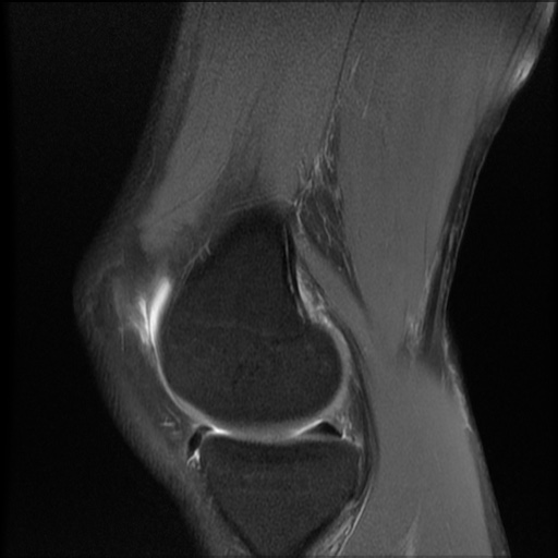 File:Bucket-handle meniscus tear (Radiopaedia 65700-74809 Sagittal PD fat sat 8).jpg