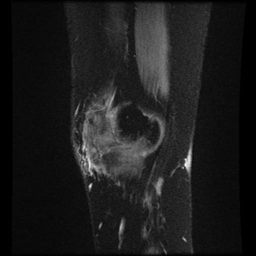 File:Bucket handle meniscus tear (Radiopaedia 56916-63751 H 78).jpg