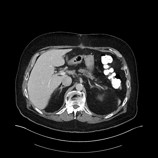 Buried bumper syndrome - gastrostomy tube (Radiopaedia 63843-72575 A 14).jpg