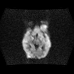 File:Burkitt lymphoma of the orbit- pre and post chemotherapy (Radiopaedia 31214-31929 Axial DWI 7).jpg