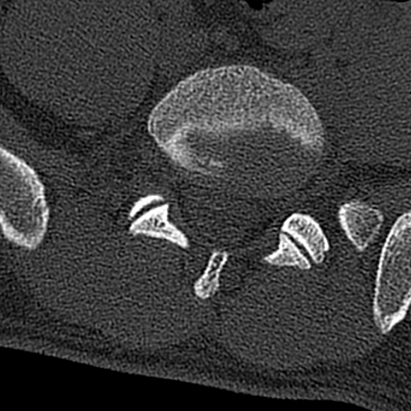 Burst fracture (Radiopaedia 53373-59357 Axial bone window 63).jpg