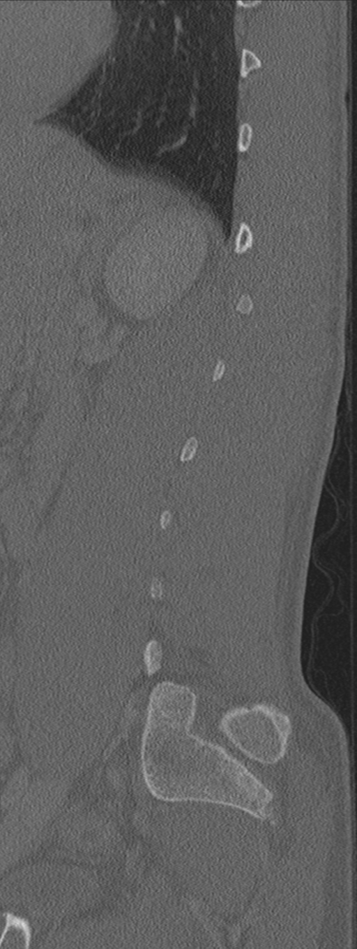 Burst fracture - T12 with conus compression (Radiopaedia 56825-63647 Sagittal bone window 18).png