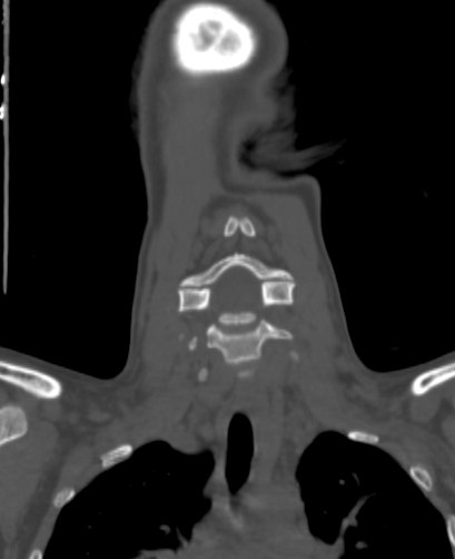 File:Butterfly vertebra (Radiopaedia 77903-90209 Coronal bone window 17).jpg