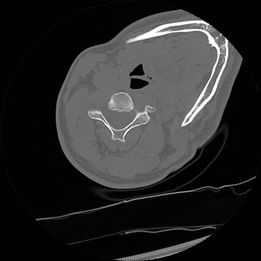 C1-C2 "subluxation" - normal cervical anatomy at maximum head rotation (Radiopaedia 42483-45607 Axial non-contrast 15).jpg