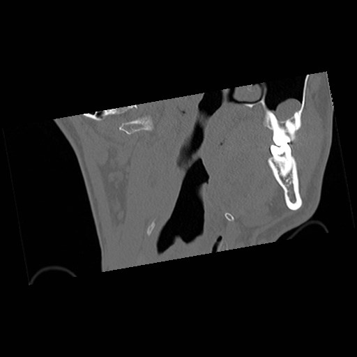 C1-C2 "subluxation" - normal cervical anatomy at maximum head rotation (Radiopaedia 42483-45607 Coronal non-contrast 1).jpg