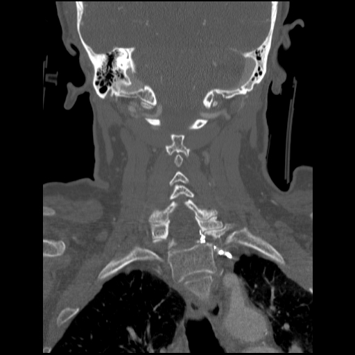 File:C1 anterior arch (plough) fracture - type 1 (Radiopaedia 76181-87720 Coronal bone window 38).jpg
