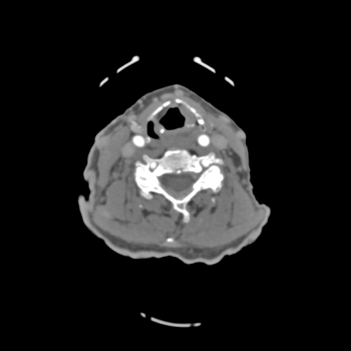 File:C2 fracture with vertebral artery dissection (Radiopaedia 37378-39200 A 117).png
