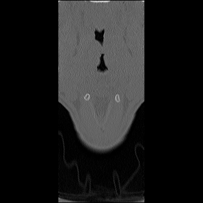 C5 facet fracture (Radiopaedia 58374-65499 Coronal bone window 6).jpg