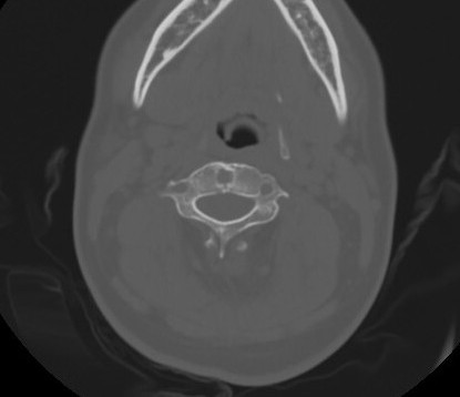 C7 laminar fracture and Klippel-Feil syndrome (Radiopaedia 86710-102850 Axial bone window 36).jpg