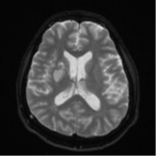 File:CNS vasculitis (Radiopaedia 55715-62263 Axial DWI 17).png