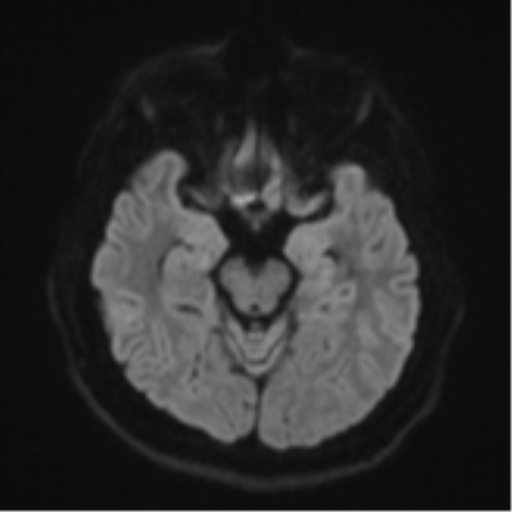File:CNS vasculitis (Radiopaedia 55715-62263 Axial DWI 40).png