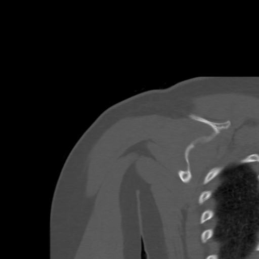 File:Calcific tendinitis of the infraspinatus tendon (Radiopaedia 87256-103539 Coronal bone window 44).jpg