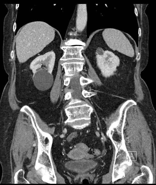Calcified adrenal glands and Spigelian hernia (Radiopaedia 49741-54988 B 77).jpg