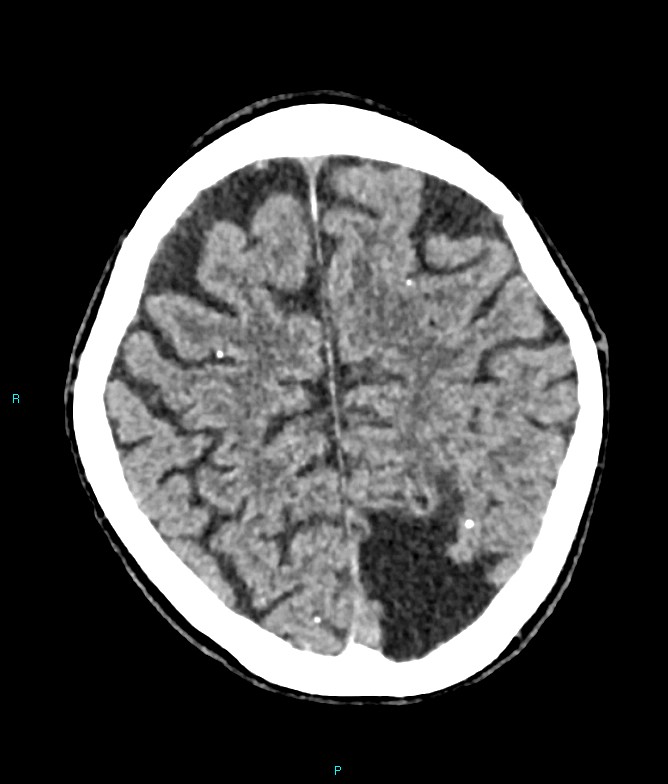 Calcified cerebral emboli from left ventricular thrombus (Radiopaedia 84420-99758 Axial non-contrast 26).jpg