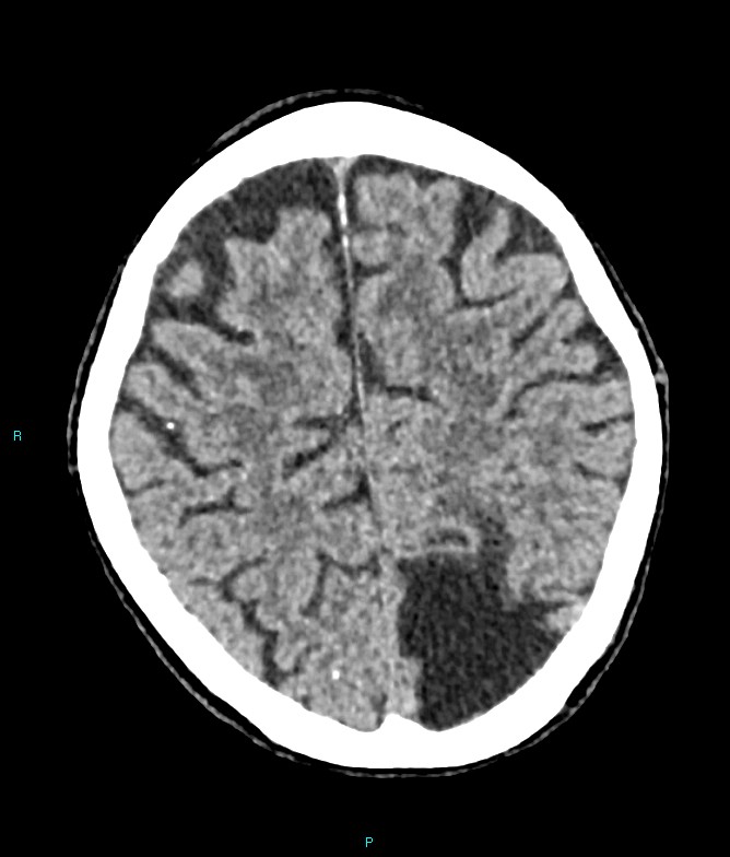 Calcified cerebral emboli from left ventricular thrombus (Radiopaedia 84420-99758 Axial non-contrast 28).jpg