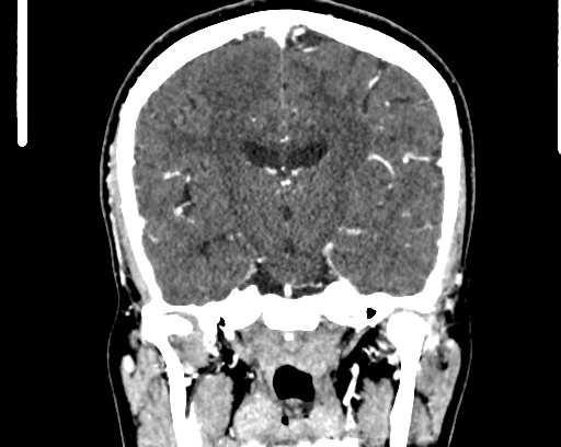 Calcified cerebral hydatid cyst (Radiopaedia 65603-74717 C 37).jpg
