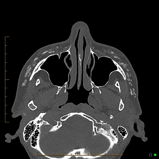 Calcified facial augmentation fillers (Radiopaedia 79514-92679 Axial bone window 35).jpg