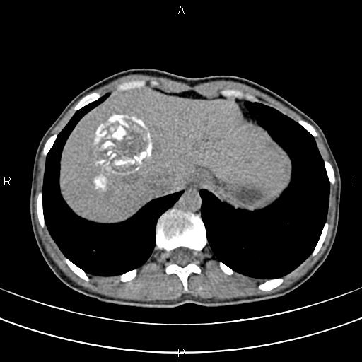 File:Calcified hepatic hydatid cyst (Radiopaedia 83870-99072 Axial non-contrast 24).jpg