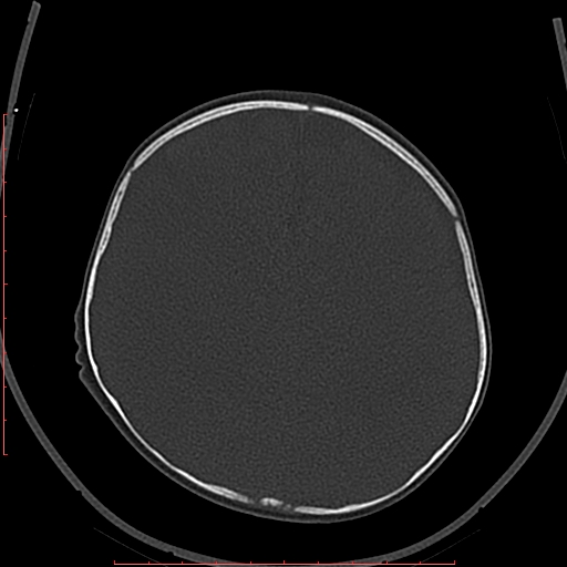 File:Calcified middle cerebral artery embolism (Radiopaedia 78949-91860 Axial bone window 47).jpg