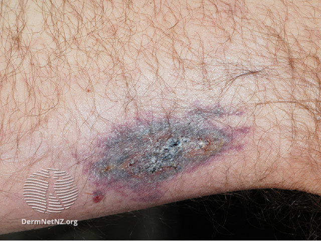 File:Calciphylaxis can lead to- (DermNet NZ systemic-calciphylaxis2).jpg