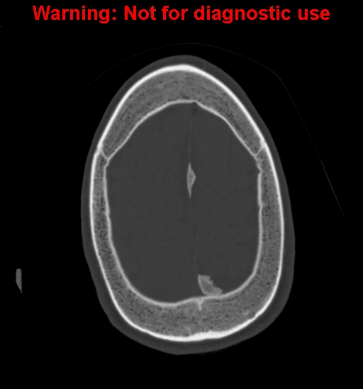 Calvarial thickening from chronic shunting (Radiopaedia 60079-67637 Axial bone window 153).jpg
