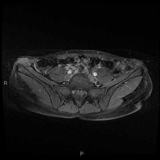 File:Canal of Nuck cyst (Radiopaedia 55074-61448 Axial T1 C+ fat sat 4).jpg