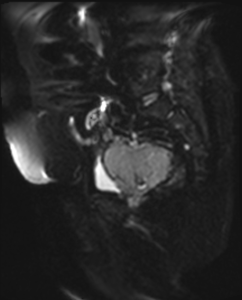 Cancer cervix - stage IIb (Radiopaedia 75411-86615 Sagittal DWI 14).jpg