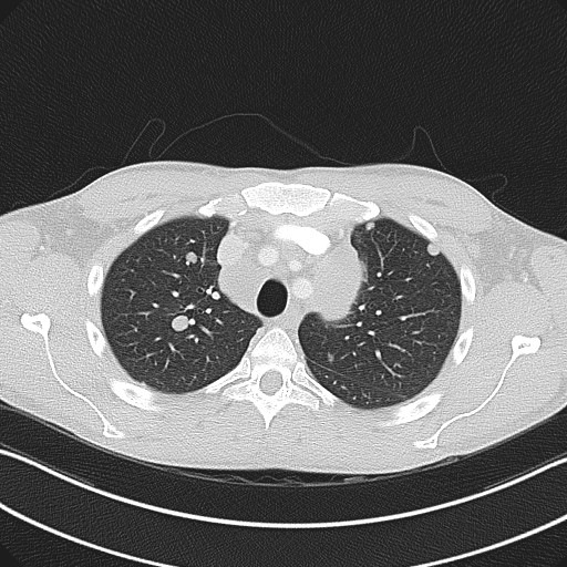 Cannonball metastases - testicular choriocarcinoma (Radiopaedia 84510-99891 Axial lung window 27).jpg