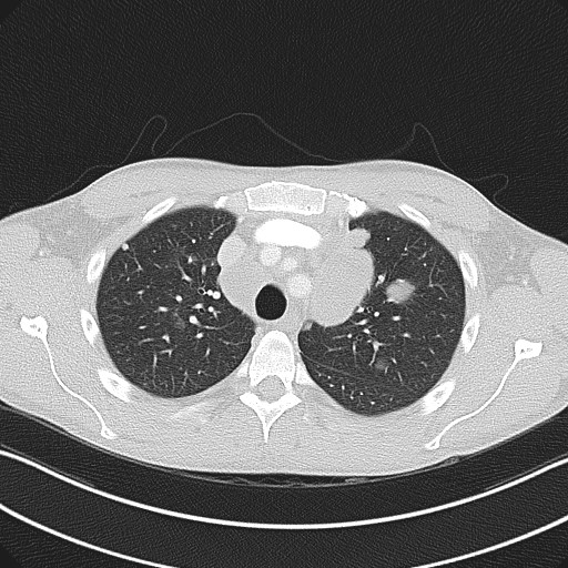 Cannonball metastases - testicular choriocarcinoma (Radiopaedia 84510-99891 Axial lung window 29).jpg