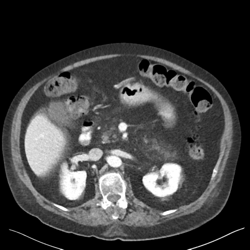Cannonball metastases from endometrial cancer (Radiopaedia 42003-45031 E 30).png