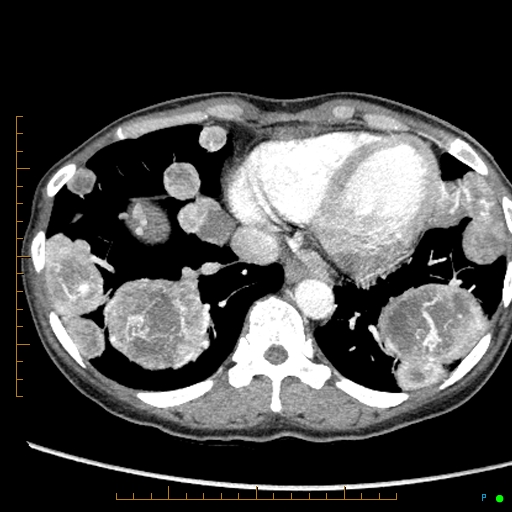 Canonball lung metastasis (Radiopaedia 77634-89837 B 77).jpg