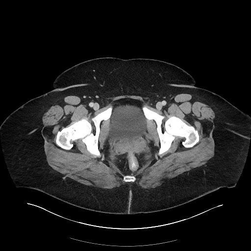 Carcinoid tumor - terminal ileum (Radiopaedia 60931-68739 A 133).jpg
