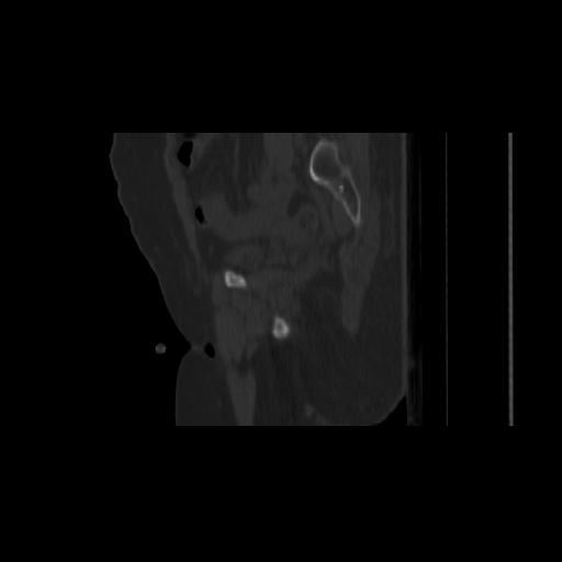 Carcinoma cervix- brachytherapy applicator (Radiopaedia 33135-34173 Sagittal bone window 52).jpg