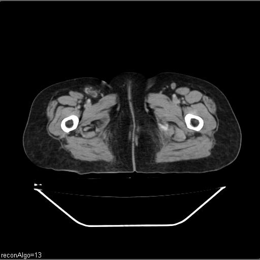 Carcinoma cervix- recurrence (Radiopaedia 34702-36137 B 58).jpg
