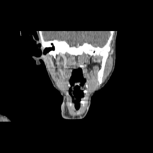 Carcinoma of the maxillary antrum (Radiopaedia 53805-59888 Coronal C+ delayed 90).jpg