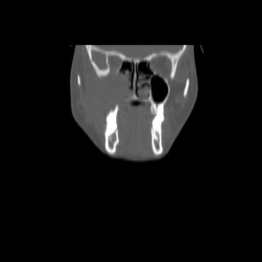 Carcinoma of the maxillary antrum (Radiopaedia 53805-59888 Coronal bone window 43).jpg