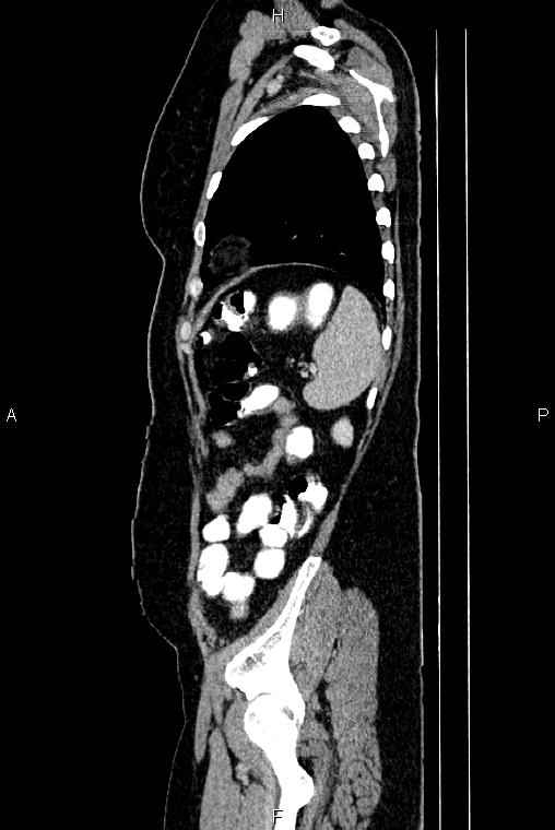 Carcinoma of uterine cervix (Radiopaedia 85861-101700 D 72).jpg