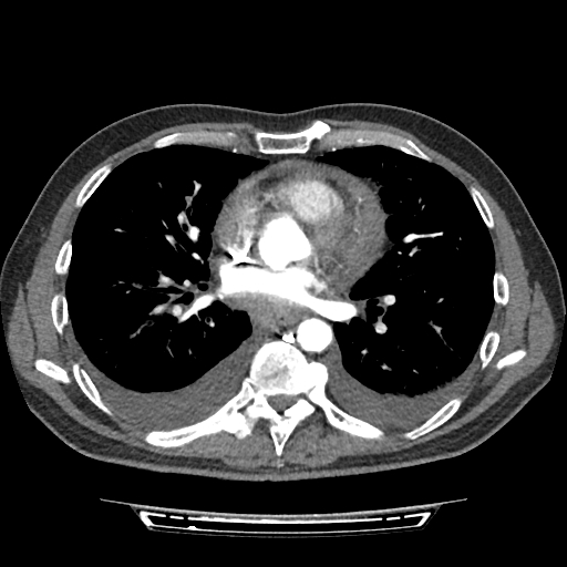 Cardiac tamponade (Radiopaedia 78607-91368 Axial C+ CTPA 49).jpg