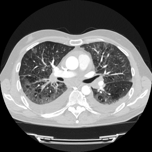 File:Cardiac tamponade (Radiopaedia 78607-91368 Axial lung window 38).jpg