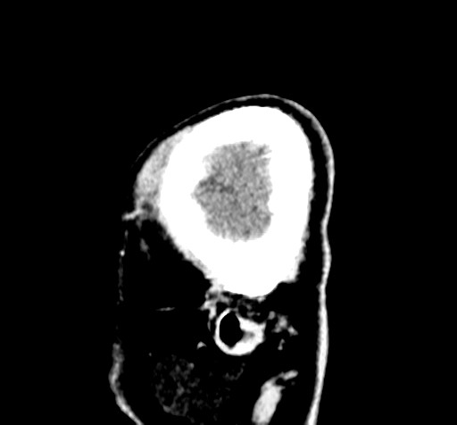 File:Cardioembolic stroke- ACA and MCA territories (Radiopaedia 58904-66140 B 144).jpg