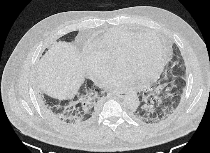 Cardiogenic pulmonary edema (Radiopaedia 68180-77678 Axial lung window 65).jpg